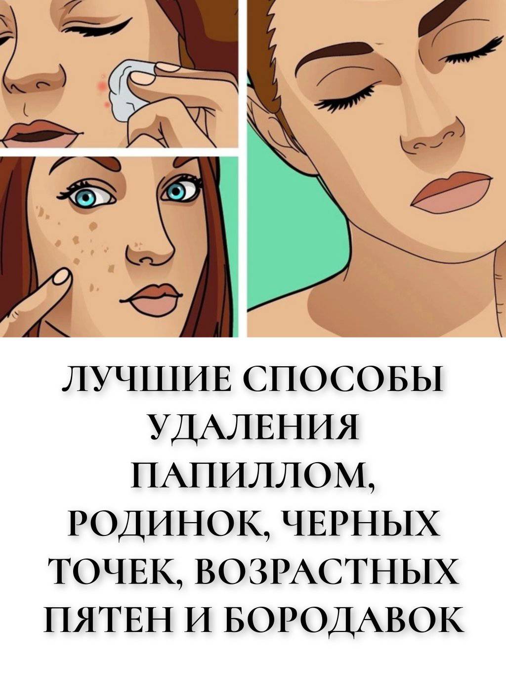 Лучшие способы удаления папиллом, родинок, черных точек, возрастных пятен и бородавок
