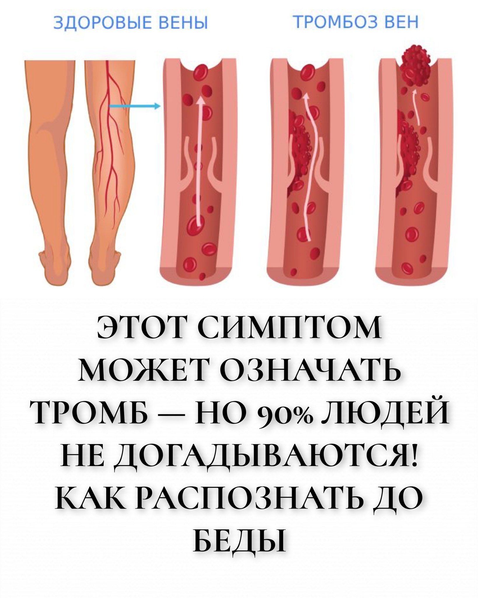 Этот симптом может означать тромб — но 90% людей не догадываются! Как распознать до беды
