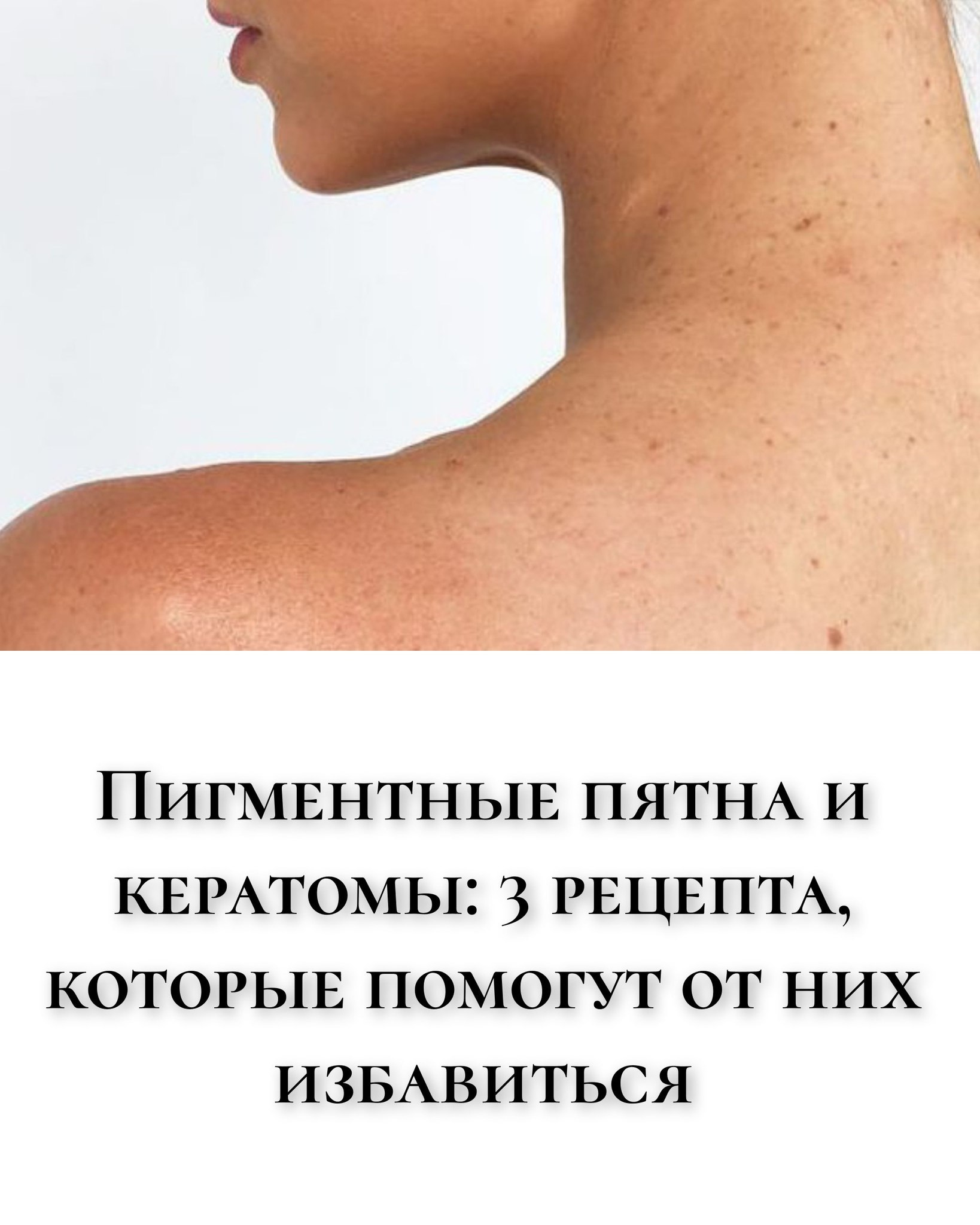 Пигментные пятна и кератомы: 3 рецепта, которые помогут от них избавиться