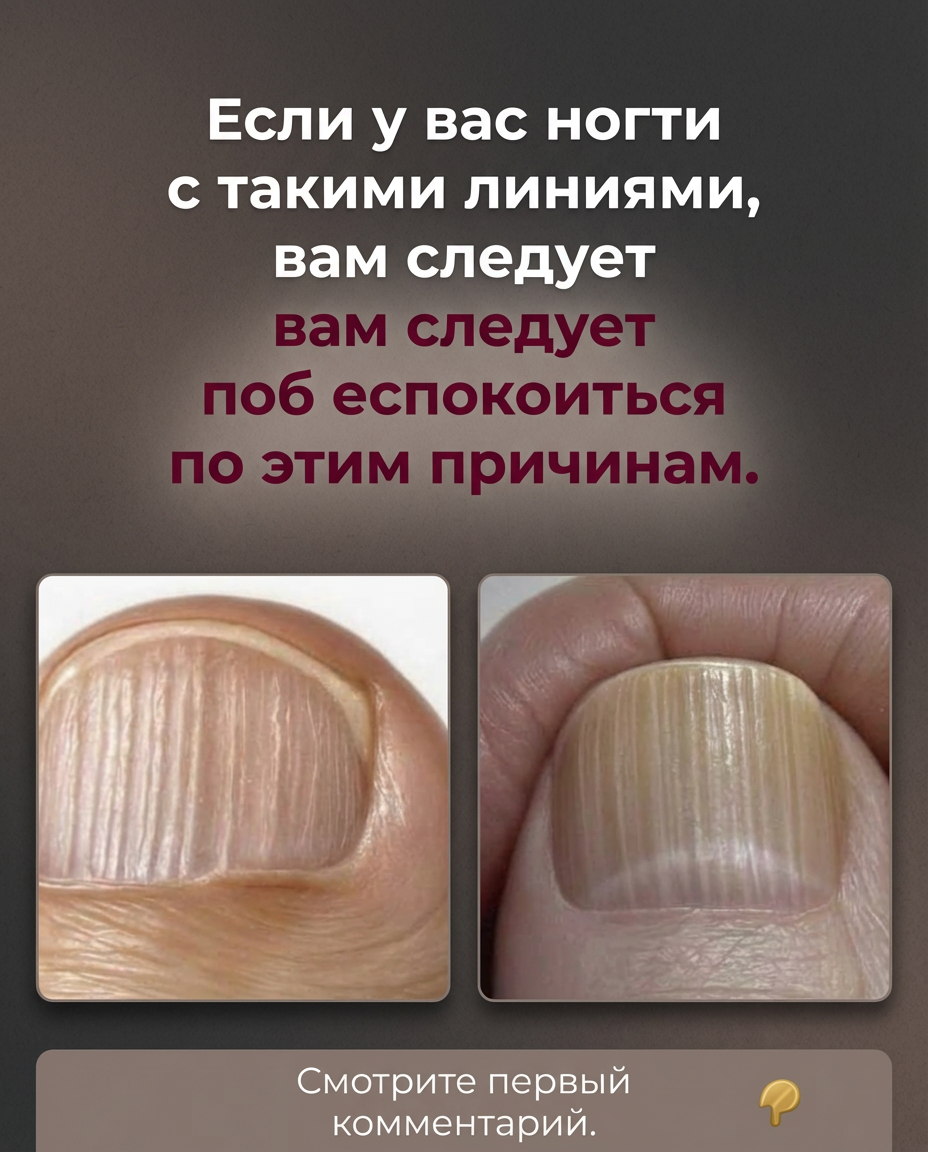 О чем говорят полоски на ногтях: причины и методы восстановления здоровья пластин